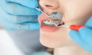 Orthodontic Treatment in Brooklyn