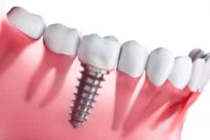 Which is Better, Immediate or Delayed Implant Placement?