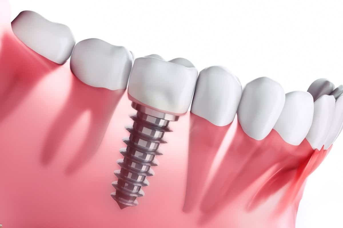Dental implant in Brooklyn illustration showing screw fixture and crown among natural teeth in gum tissue.