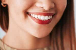 How to Clean Porcelain Veneers?