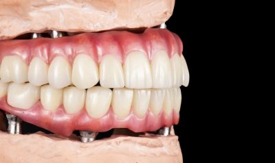 Can You Have a Full Mouth of Dental Implants?