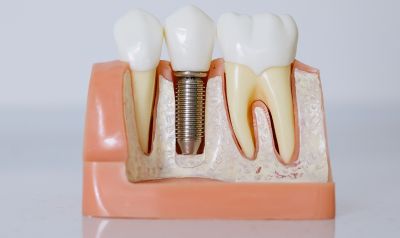 How Dental Implants Are Installed?