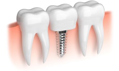 Is it Okay to Have an MRI with Dental Implants?