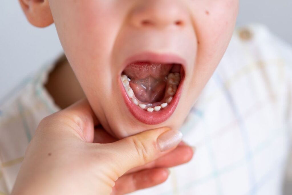 Young child displaying primary teeth during dental development milestone examination.