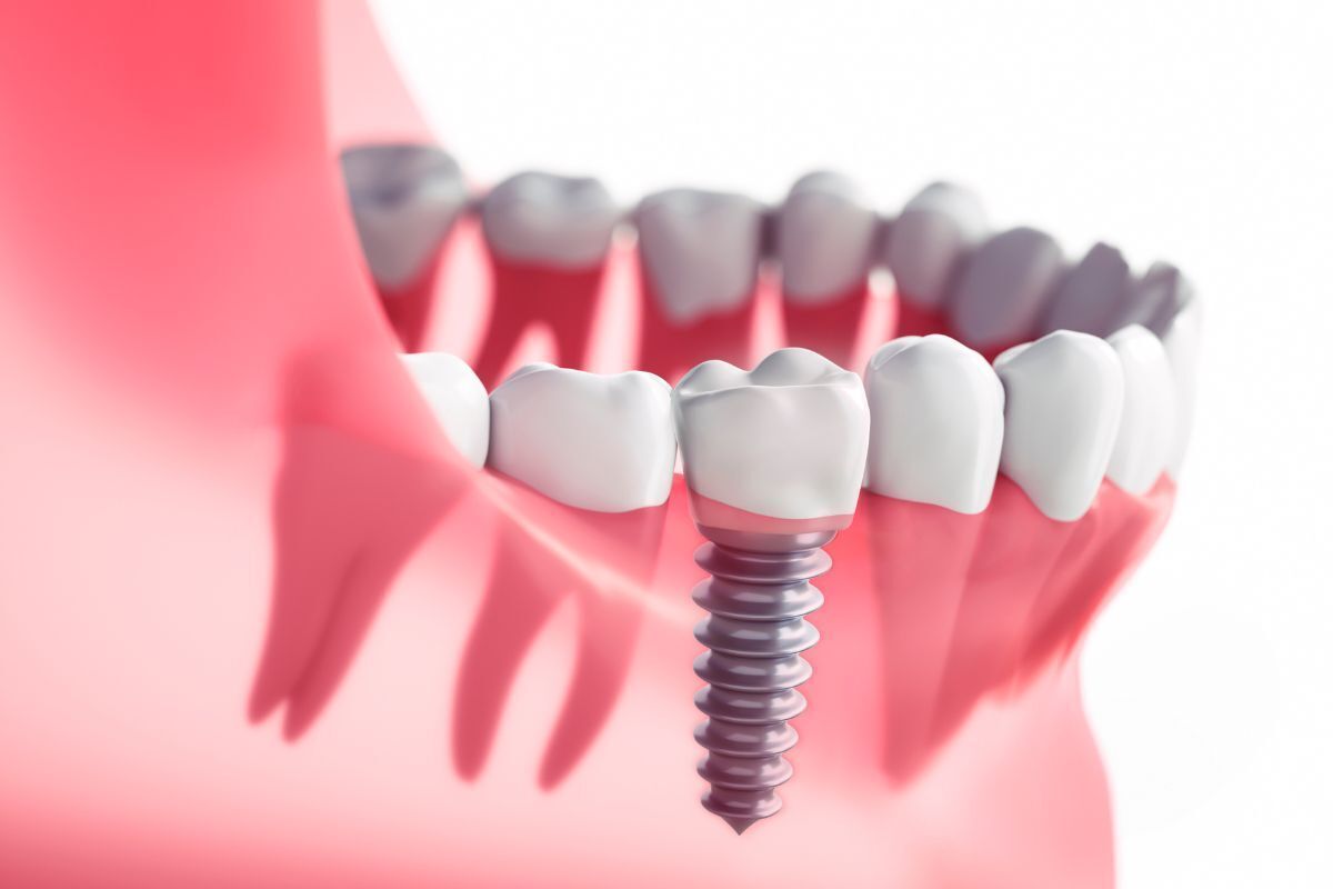 Dental implant illustration showing a screw-retained implant among natural teeth in the jaw.
