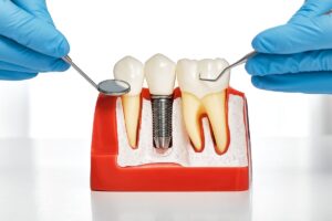 Can implants work with gum disease?