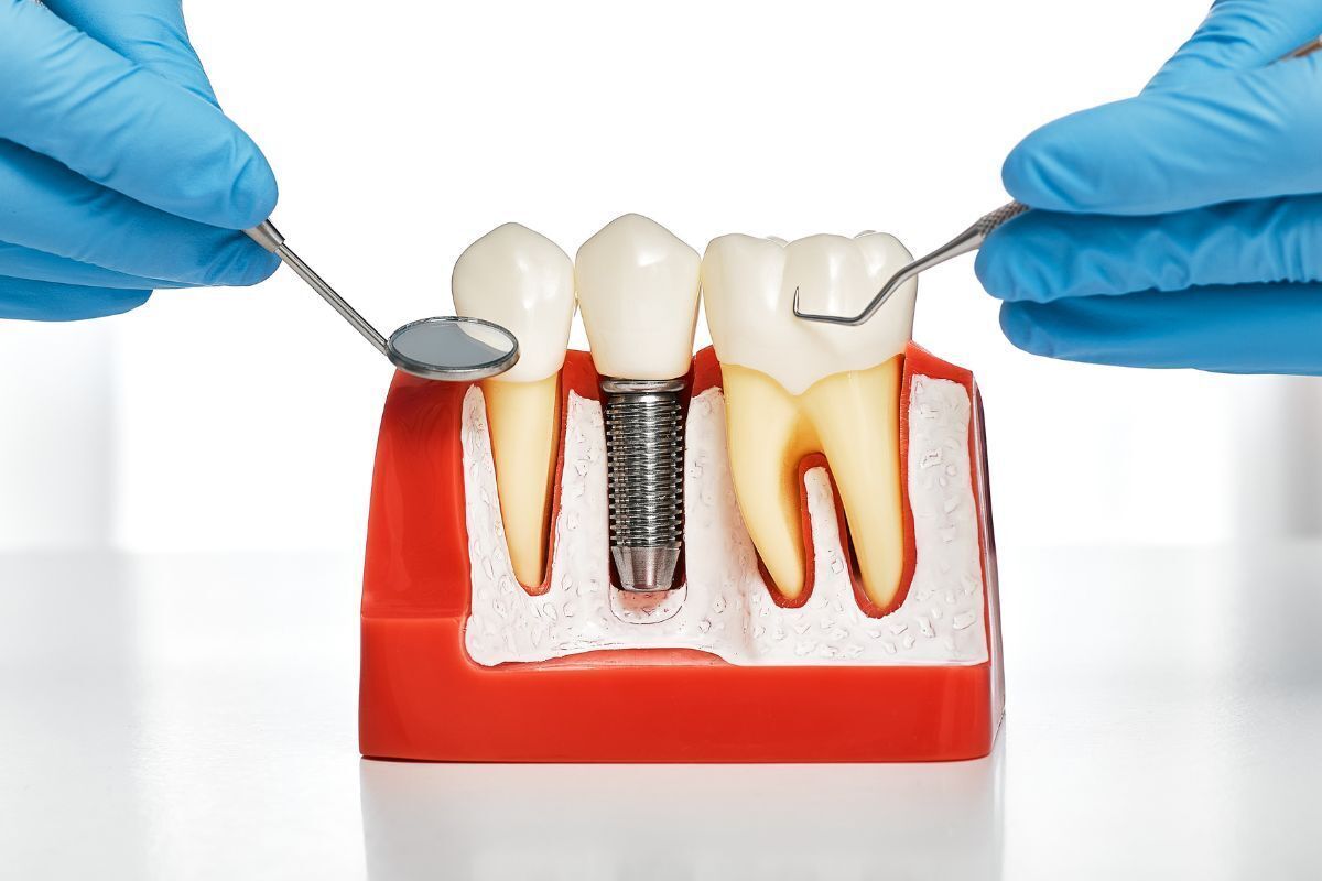 Dental implant model showing tooth replacement with crown on metal implant post between natural teeth.