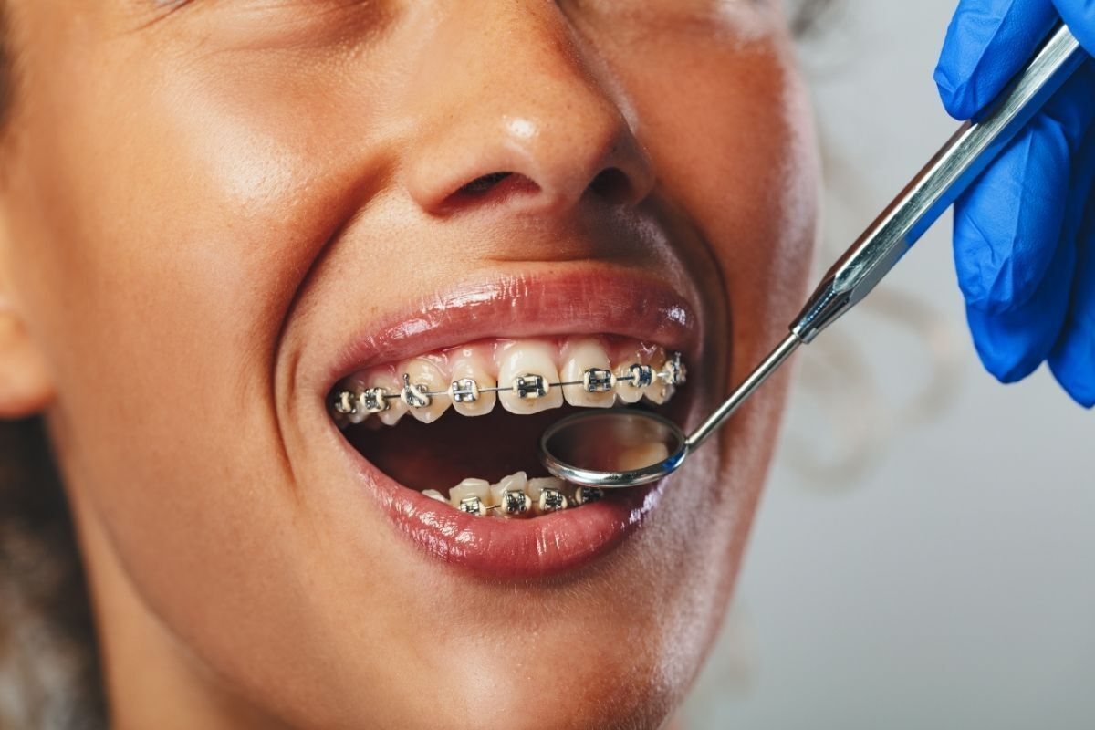 Close-up of metal braces on upper and lower teeth during orthodontic examination with dental mirror.