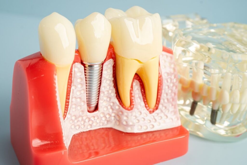 How Do Dental Implants Prevent Teeth From Shifting?