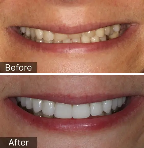 Before and after smile transformation showing improved teeth whiteness and alignment in Brooklyn.