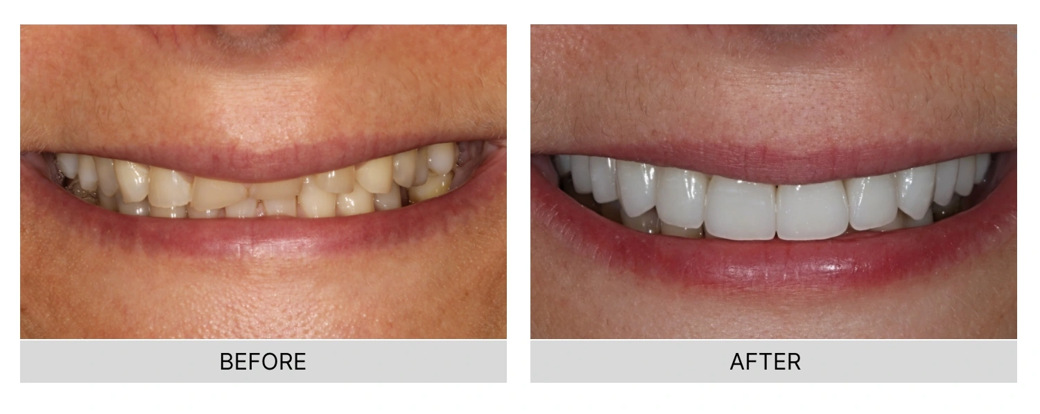Professional Teeth Whitening