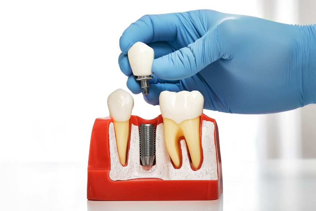 When to Choose Dental Implants After Tooth Loss?