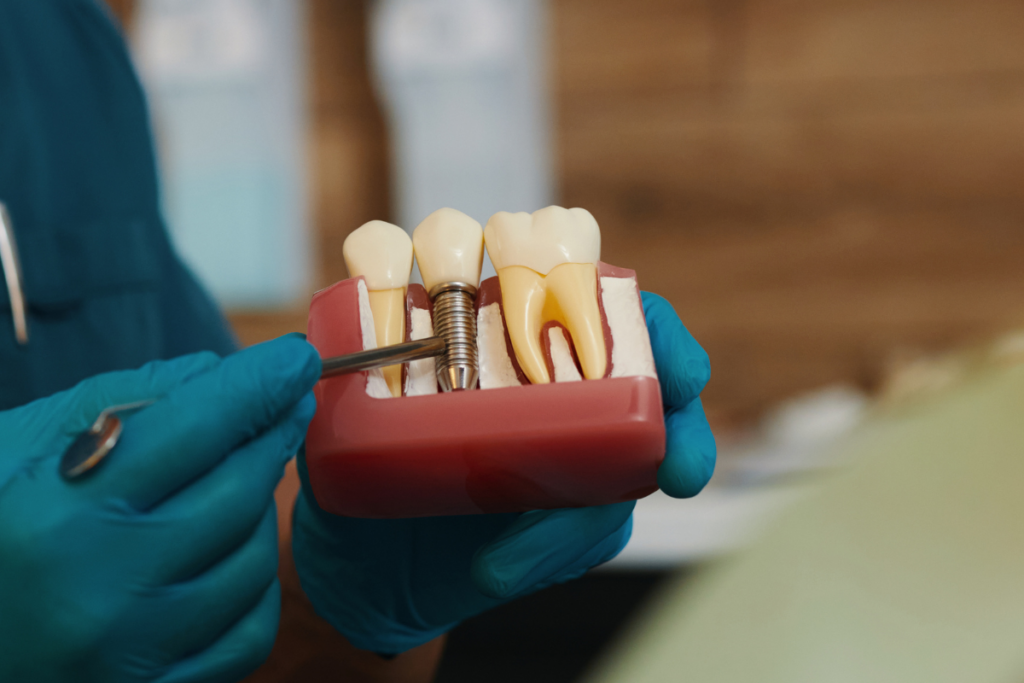 How to Clean Dental Implants: What Is Different From Natural Teeth