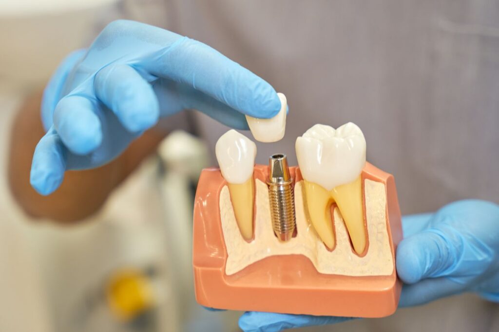 Dental Implants vs. Dental Bridges: Which Is Better?