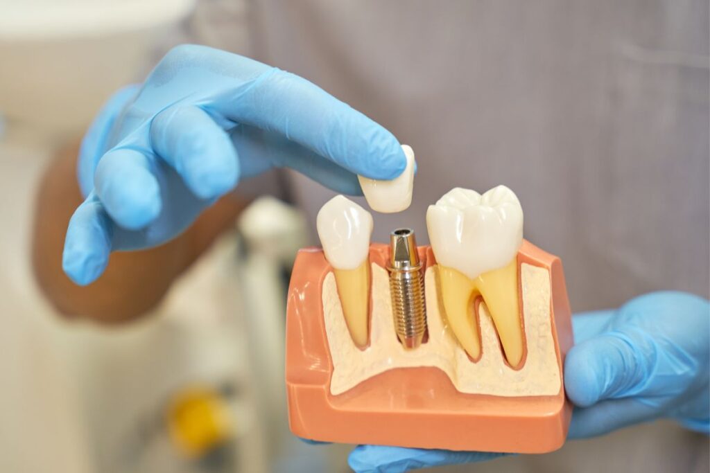 When Do Dental Implants Need to Be Replaced?