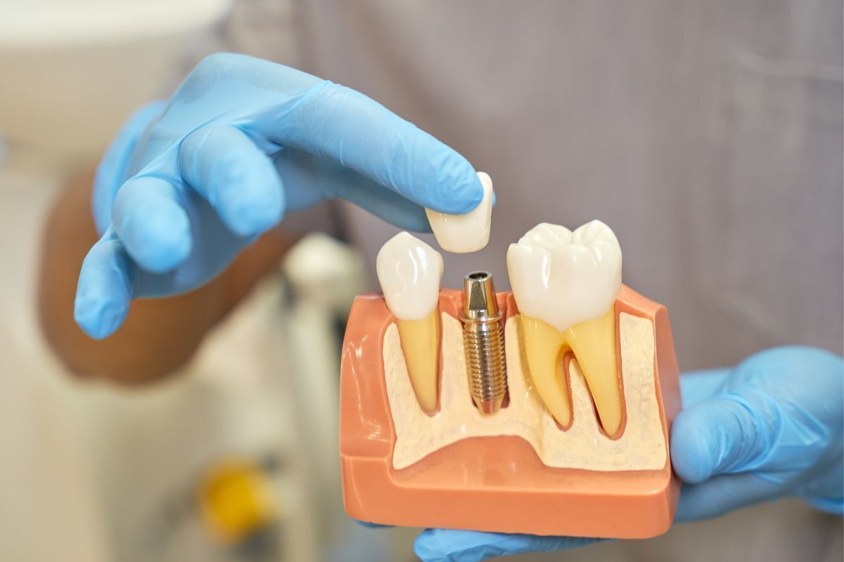 Dental implant model showing replacement tooth and metal implant fixture in jawbone model.