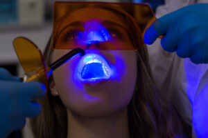 Teeth Whitening in Sunnyside
