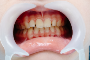 Swollen Gums: Signs You Need Emergency Dental Care