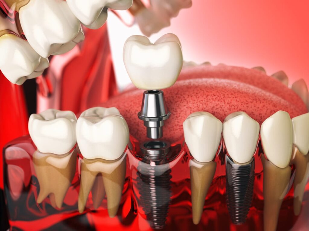Dental Implants in Brooklyn