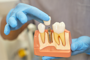 Dental Implants After Tooth Injury: What to Know
