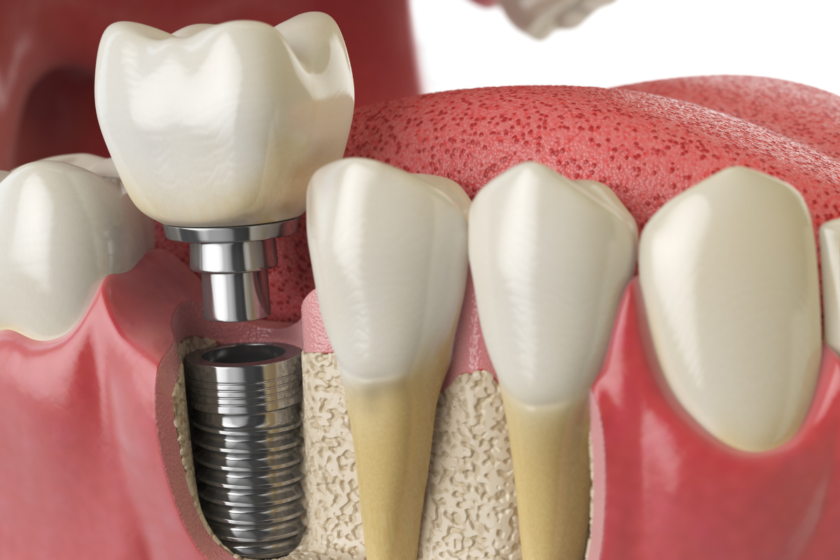 Replacing a Front Tooth? What to Know Before Choosing Dental Implants