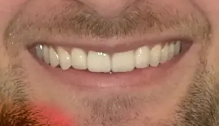 After dental treatment showing a brighter, more uniform smile.