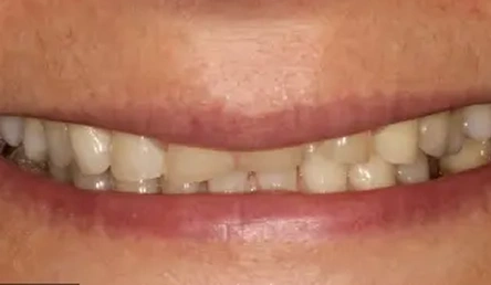 Before dental treatment showing a close-up smile with uneven, discolored teeth.