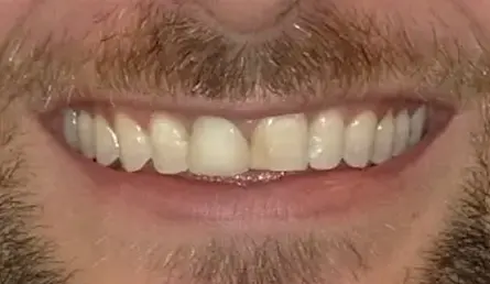 Before dental treatment showing a close-up of a smile with natural teeth.
