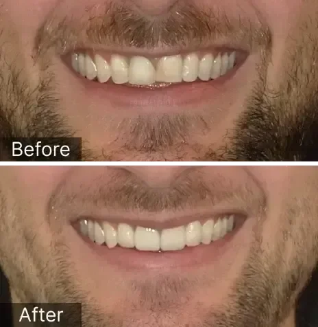 A mixture of 4 veneers and crowns to upgrade his smile