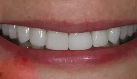 After dental treatment showing a brighter smile with straighter, more uniform teeth.