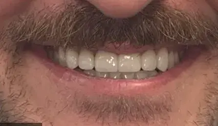 After dental treatment showing a brighter, more even smile with improved tooth appearance.
