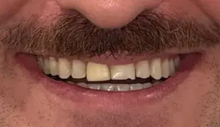 Before dental treatment showing a close-up smile with uneven and discolored teeth.
