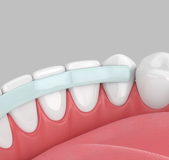 Illustration showing dental bonding material being applied to a tooth