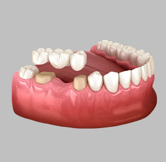 Dental bridge replacing missing teeth between natural teeth