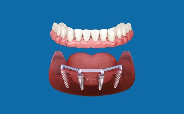 Dental illustration showing a full set of teeth supported by four implants