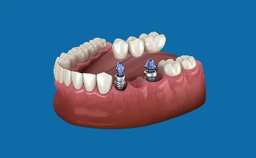 Dental illustration showing a full arch of teeth supported by dental implants and bridges