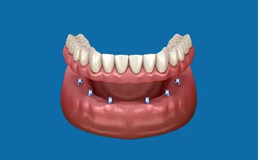 Dental illustration showing dentures supported by dental implants