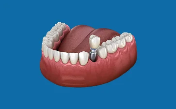 Dental illustration showing a single tooth implant with a crown