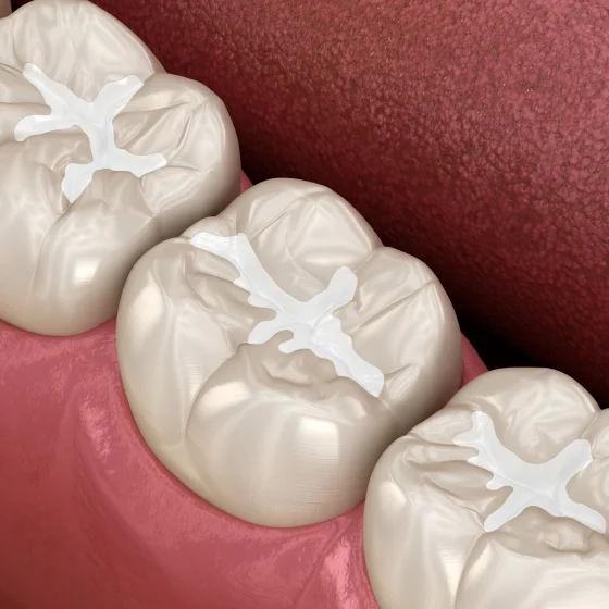 Illustration of dental sealant being applied to the grooves of a molar