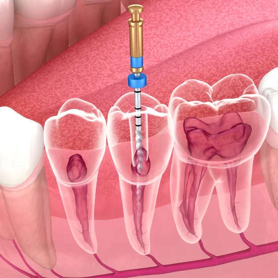 Dental illustration showing teeth and gums with highlighted tooth roots and nerves