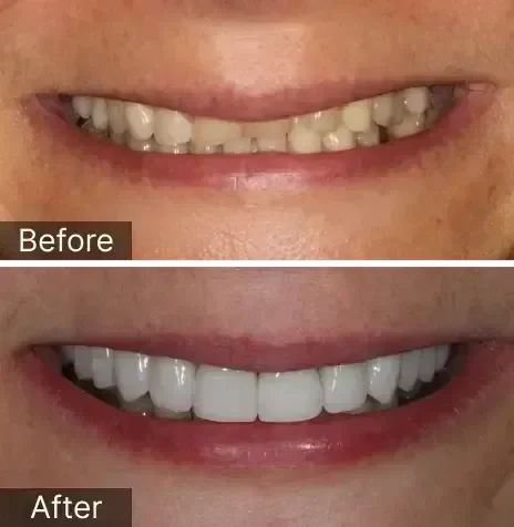 Presented with severe wear, full upper arch custom ceramic crowns placed to open up the patient’s bite and give her back her smile