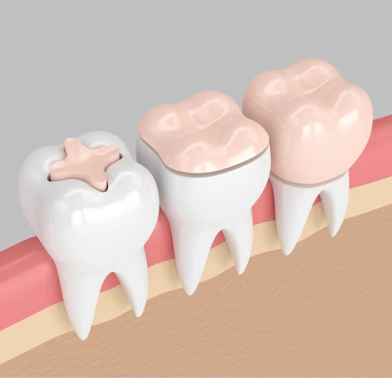 Dental inlays shown restoring damaged teeth