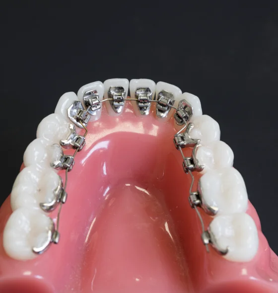 Close-up dental illustration of clear aligners fitted over teeth