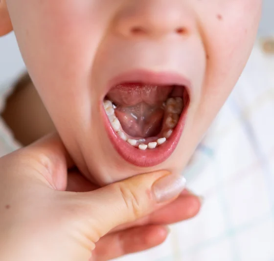 Close-up of an open mouth showing the tongue and underside of the tongue