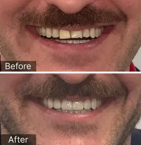 Ortho then crown and veneers