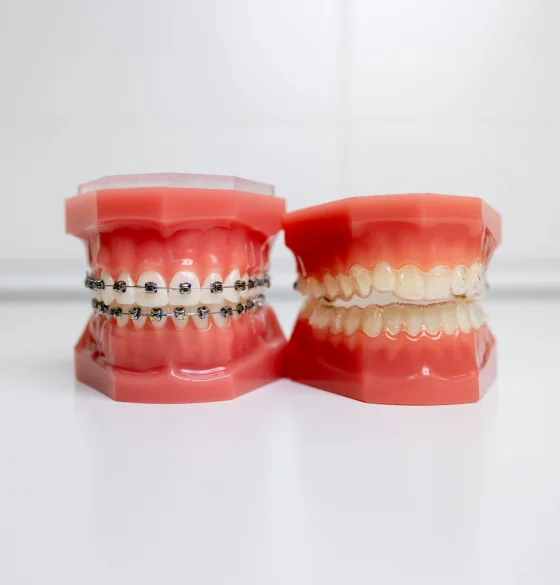 Dental illustration showing upper and lower teeth with orthodontic braces