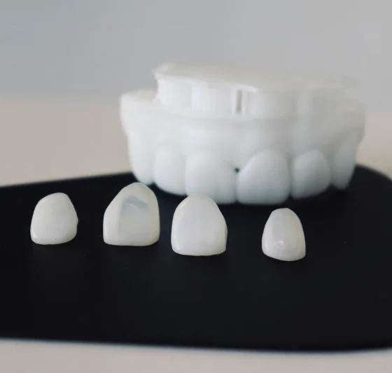 Dental illustration showing porcelain veneers placed over front teeth