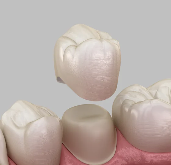 Dental crowns shown over prepared teeth