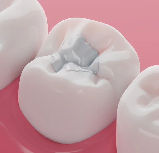 Illustration showing a tooth with a tooth-colored filling