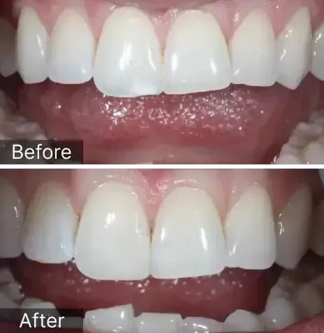 White spot removal and cosmetic bonding